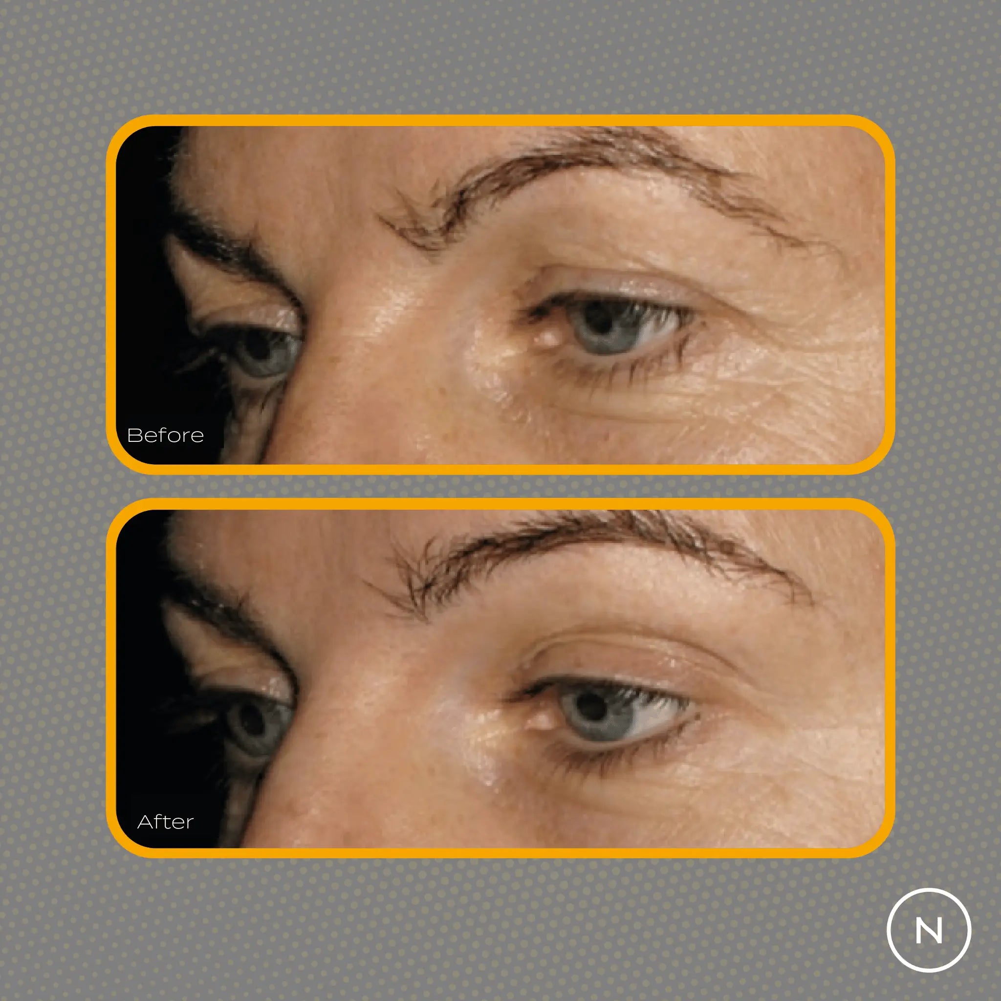 Before and after skin comparison highlighting eye area changes.