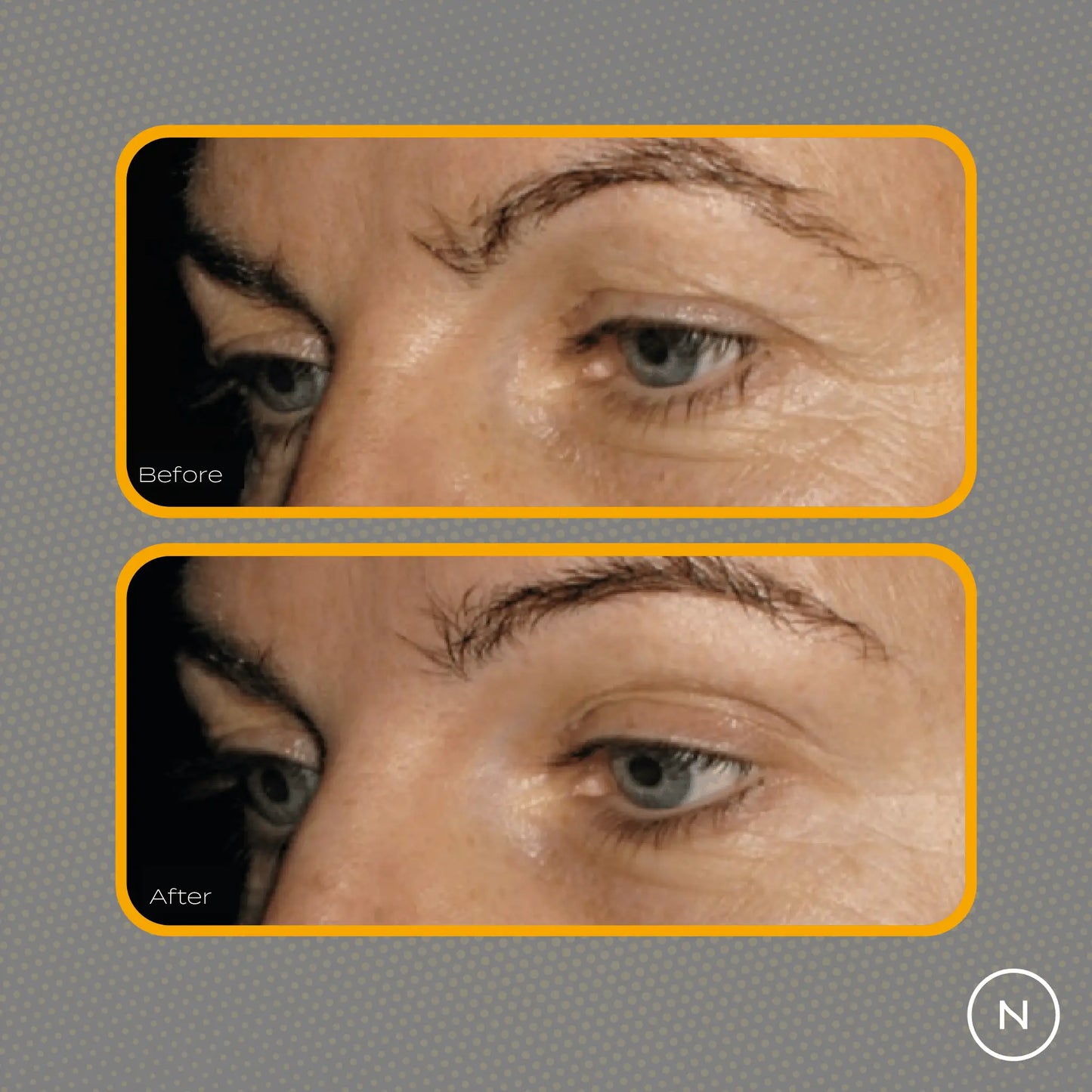 Before and after skin comparison highlighting eye area changes.